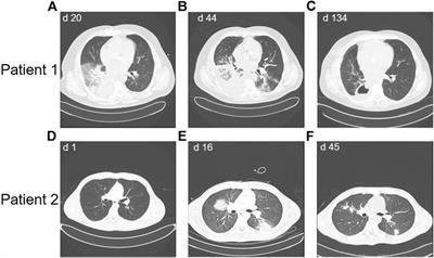 Continuous Complete Remission in Two Patients with Acute Lymphoblastic Leukemia and Severe Fungal Infection Following Short-Term, Dose-Reduced Chemotherapy